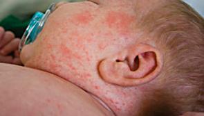 Chief medical officer 'very concerned' about rise of measles in Ireland 