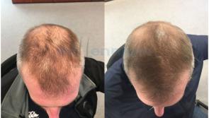 Millennium Hair Restoration Clinic - offering life changing, confidence building services with great success