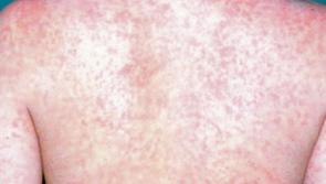 Fourth case of measles confirmed in Ireland amid HSE alert