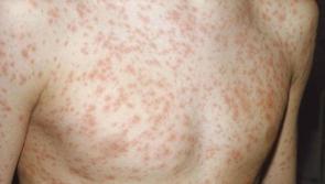 HSE urges Dublin flight passengers to come forward after third measles case confirmed in Ireland