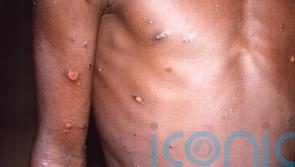 Northern Irish authorities urge vigilance as almost 30 cases of monkeypox detected