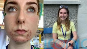 Irish teacher whose acne beard scared her pupils finds solution using AI technology