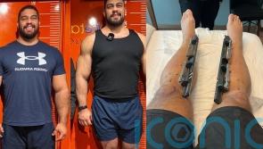 Dad of two spends &euro;100k lengthening his limbs to increase height from 6ft to 6ft 7in