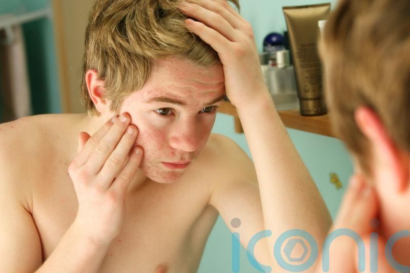 EXPLAINED: How to support a teenager who has acne